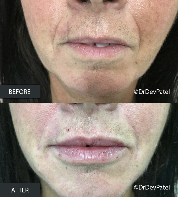 Close-up of a person's lips and surrounding skin showing before and after skin treatment, with improved complexion in the after image.