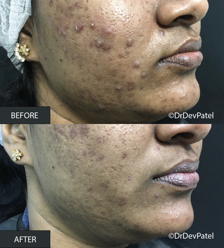 A side-by-side comparison of a person's face showing improvement in acne and skin condition after treatment. The 'before' image shows severe acne with many inflamed pimples, while the 'after' image shows reduced acne and clearer skin.