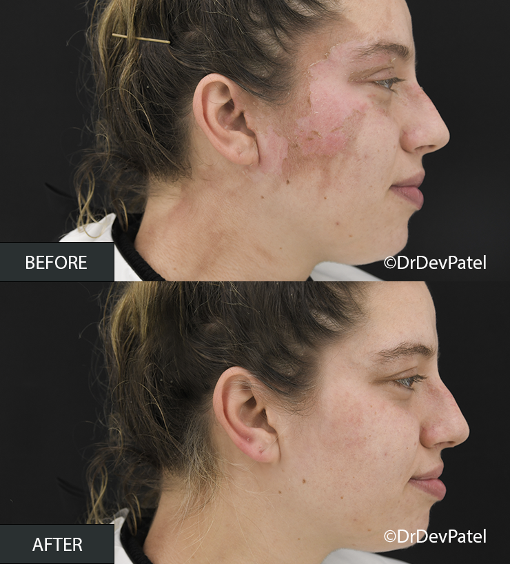 Side-by-side comparison photo showing a woman's face before and after a treatment. The "before" image reveals visible skin issues, such as redness, discoloration, and uneven texture. The "after" image displays clearer, smoother, and more even-toned skin.
