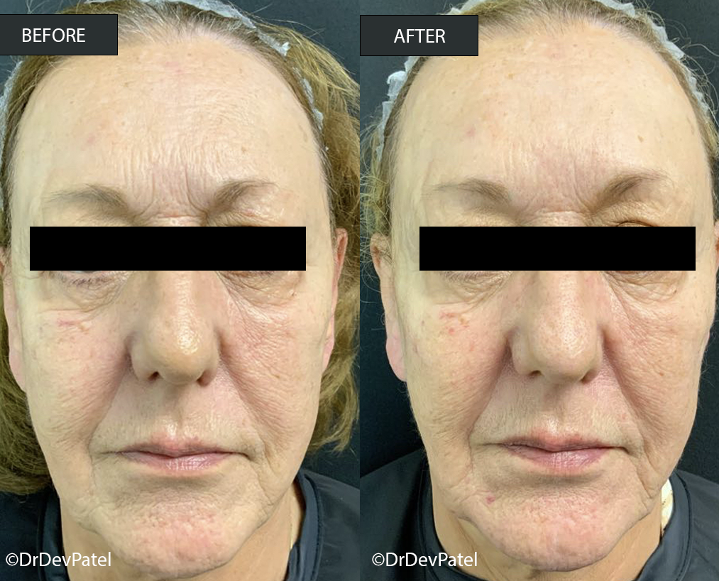 Comparison of a woman's face before and after a cosmetic procedure, showing reduced wrinkles and improved skin texture.