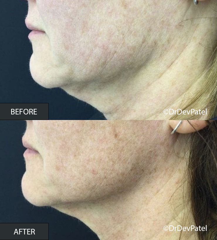 Side-by-side comparison showing a person's jawline and neck area before and after a skincare treatment. The 'before' image displays skin with visible signs of aging, such as sagging and wrinkles. The 'after' image shows smoother, tighter skin with fewer wrinkles.