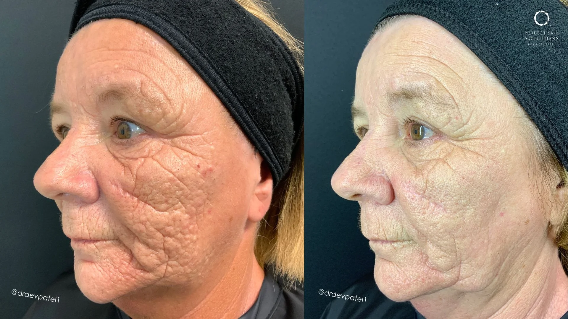 Side-by-side comparison of a woman's face showing before and after skin treatment, with visible improvements in skin texture and reduction of wrinkles.