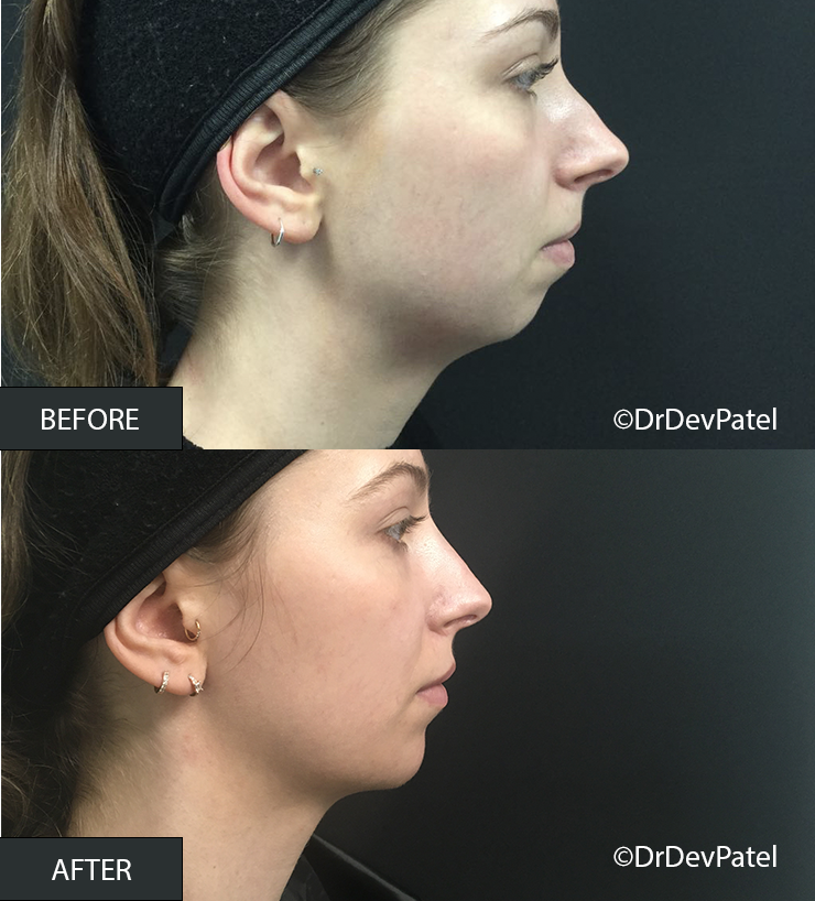 Side-by-side comparison of a woman's profile before and after a cosmetic procedure, showing a more refined jawline and chin in the after image.