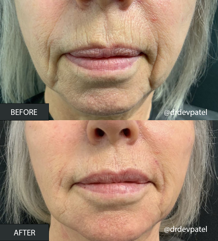 Dermal Fillers b&a.png