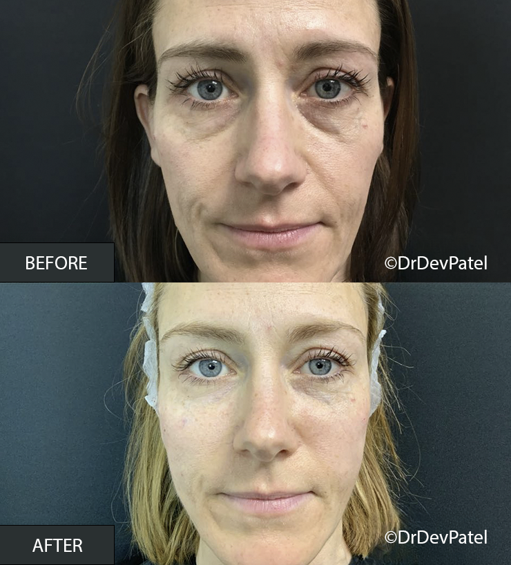 Side-by-side comparison of a woman's face showing skin improvements in the after photo, with visible reduction in under-eye bags, smoother skin texture, and fewer wrinkles.