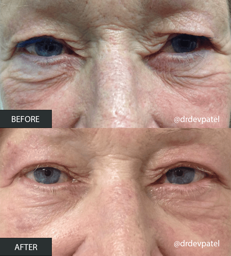 before and after plexr eyes.png