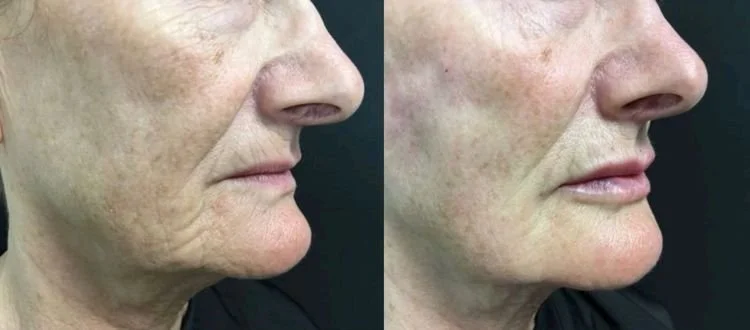 Side-by-side comparison of a person's face showing improved skin texture and reduced wrinkles after treatment.