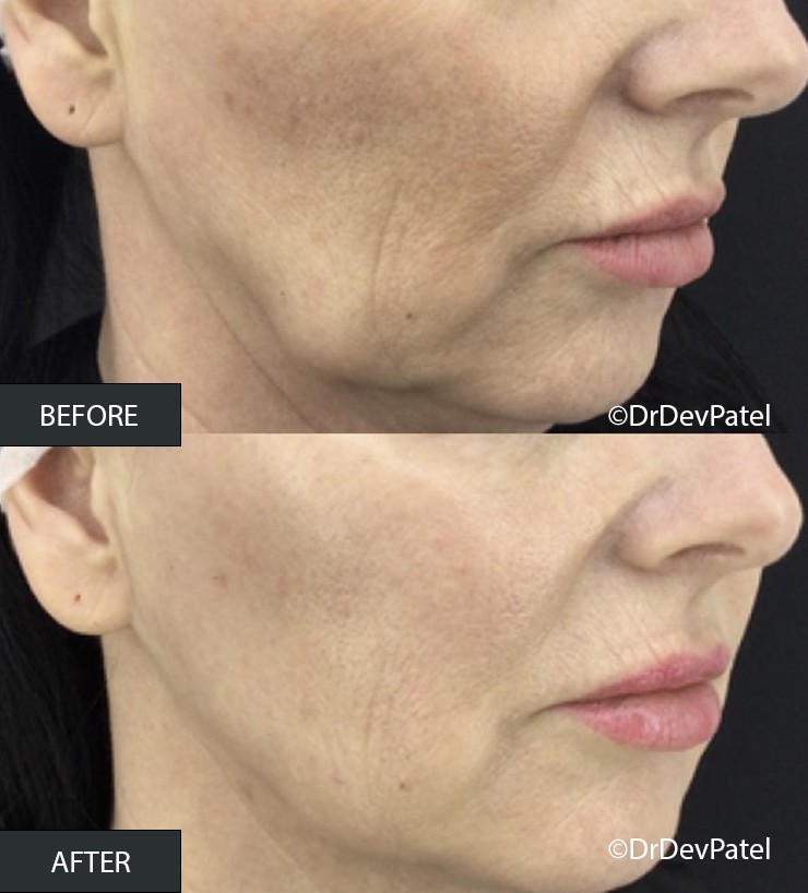 Before and after images showing the lower face of a woman, demonstrating skin improvements. The 'before' image shows more wrinkles and uneven skin texture, while the 'after' image shows smoother, more even skin with reduced wrinkles.
