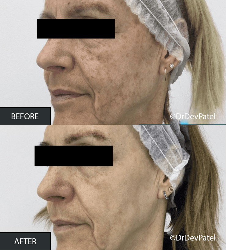 Comparison of a woman's face before and after skin treatment, showing reduced pigmentation and wrinkles.