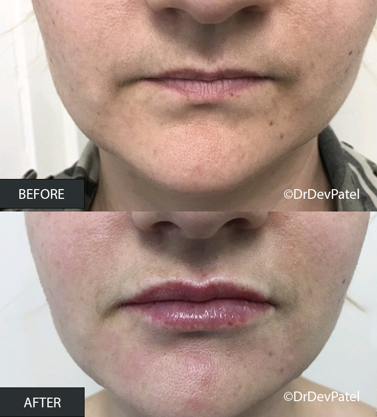 Comparison of lips before and after cosmetic treatment. The 'before' shows dry, chapped lips with little shine, while the 'after' displays moisturized, glossy lips with improved appearance.