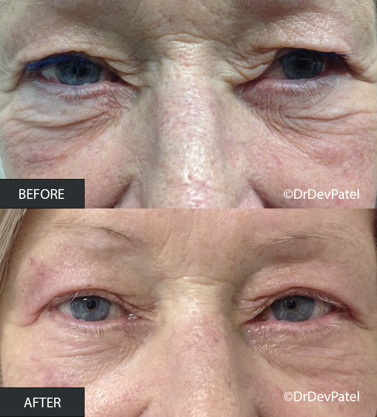 Close-up comparison of a person's eyes showing reduction in wrinkles and skin redness in the 'after' image following treatment or skincare.