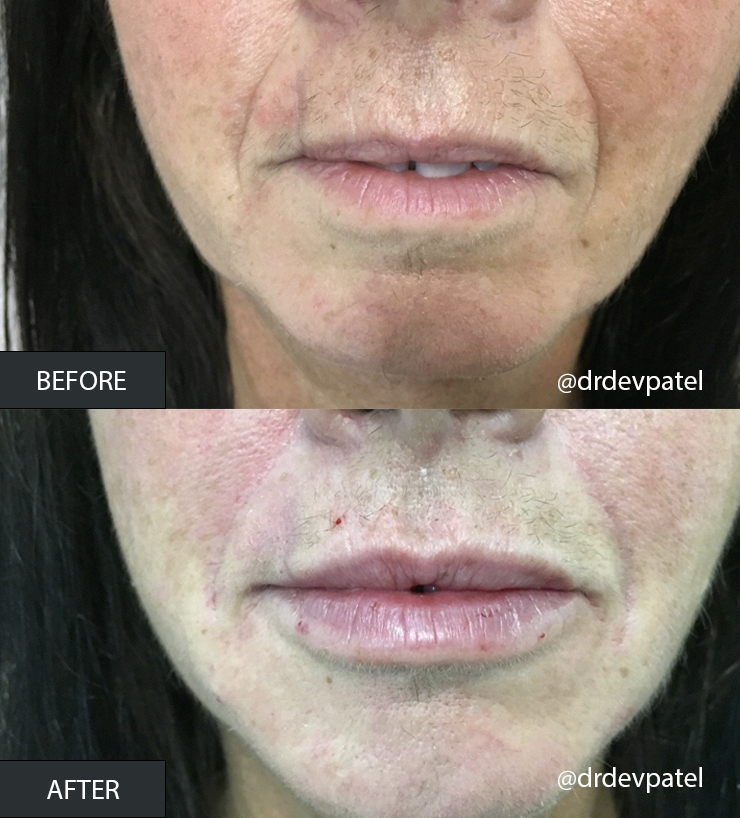 tonia dermal fillers b&a.png