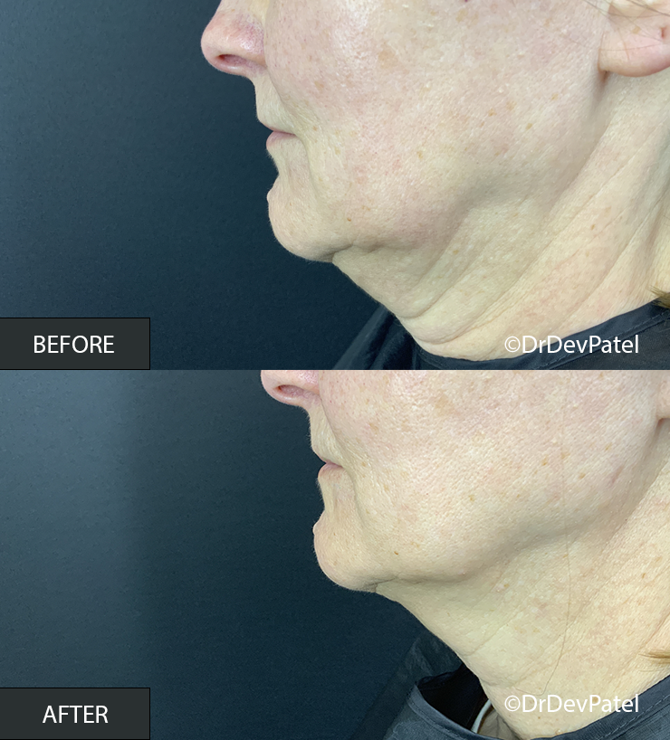 Side-by-side comparison of a person's jawline and neck before and after cosmetic treatment, showing improvement in skin tightness and reduction of sagging.