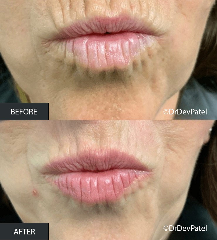 Close-up of lips before and after a cosmetic procedure showing smoother and fuller lips in the after photo.