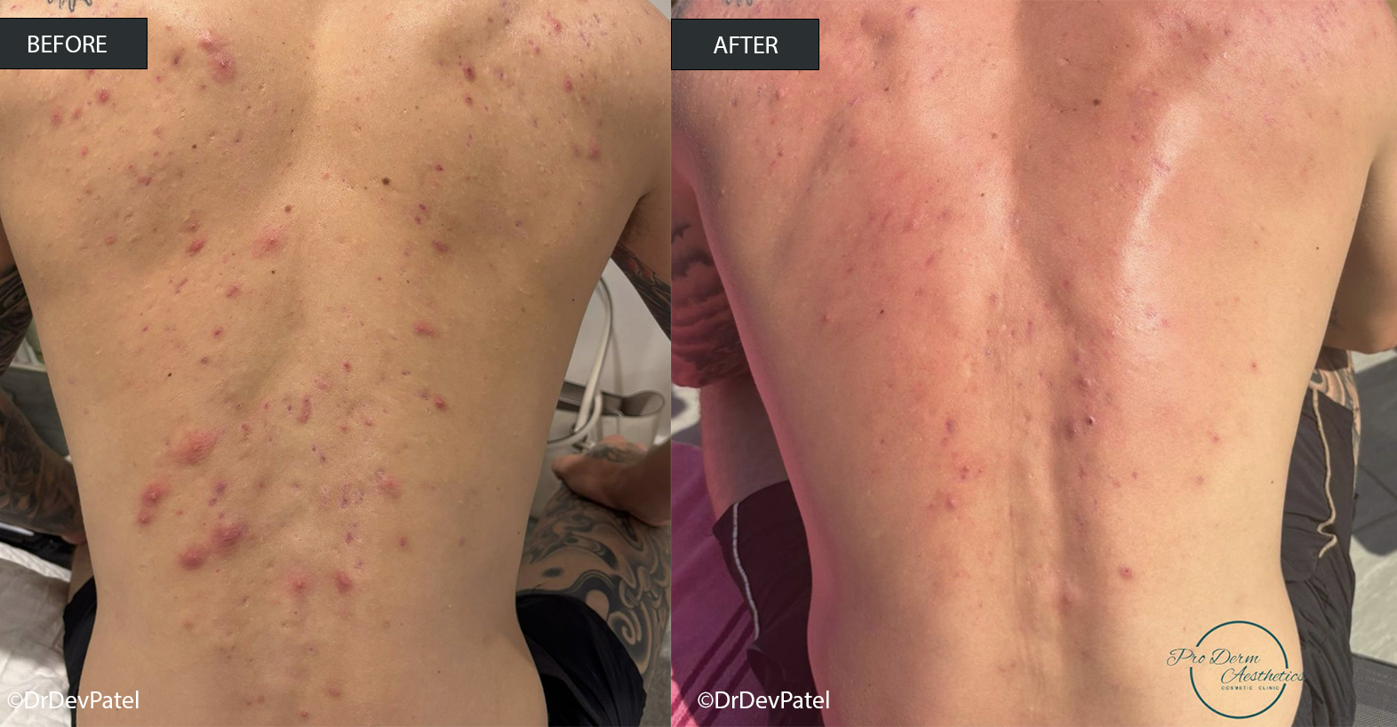 Comparison of a person's back before and after dermatological treatment showing significant reduction in acne and skin blemishes.