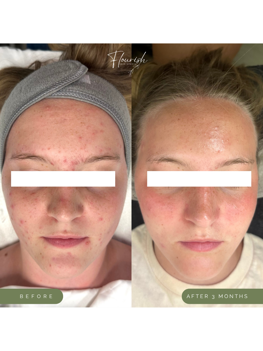Results after using a custom home-care regimen and biweekly custom facials.