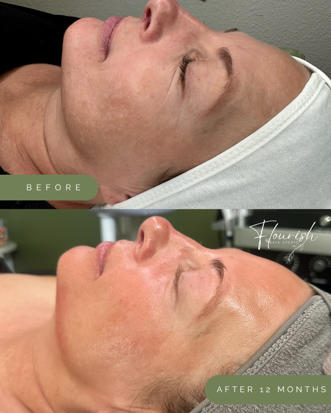 What Is the Best Facial for Aging Skin in Tacoma &amp; University Place, WA?