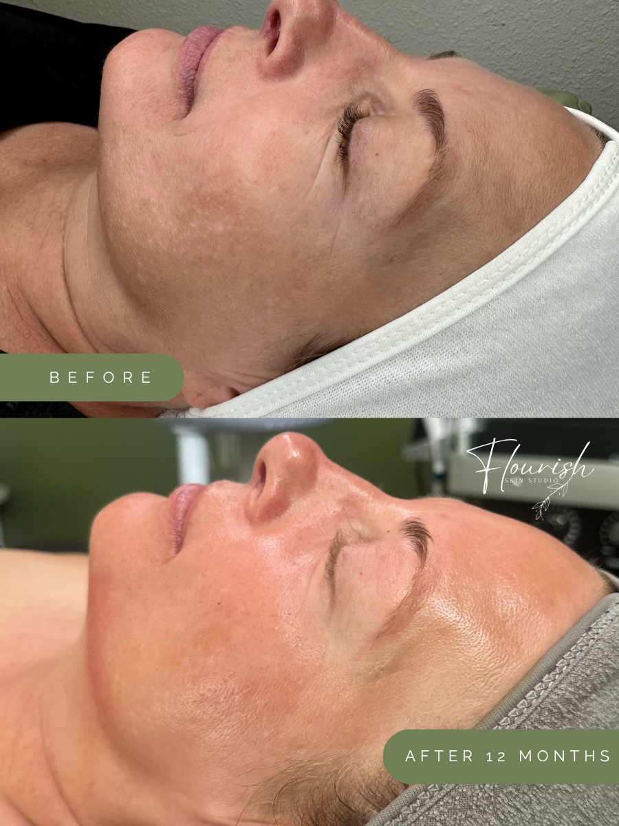 Results after one year of a custom home-care regimen, a series of chemical peels, custom facials, and microneedling.