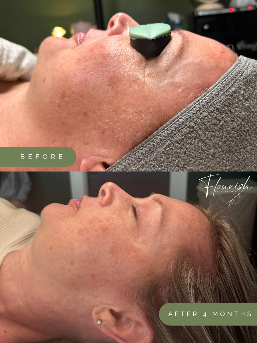 Results after 4 months of a custom home-care regimen, one custom facial, and 5 custom peels.