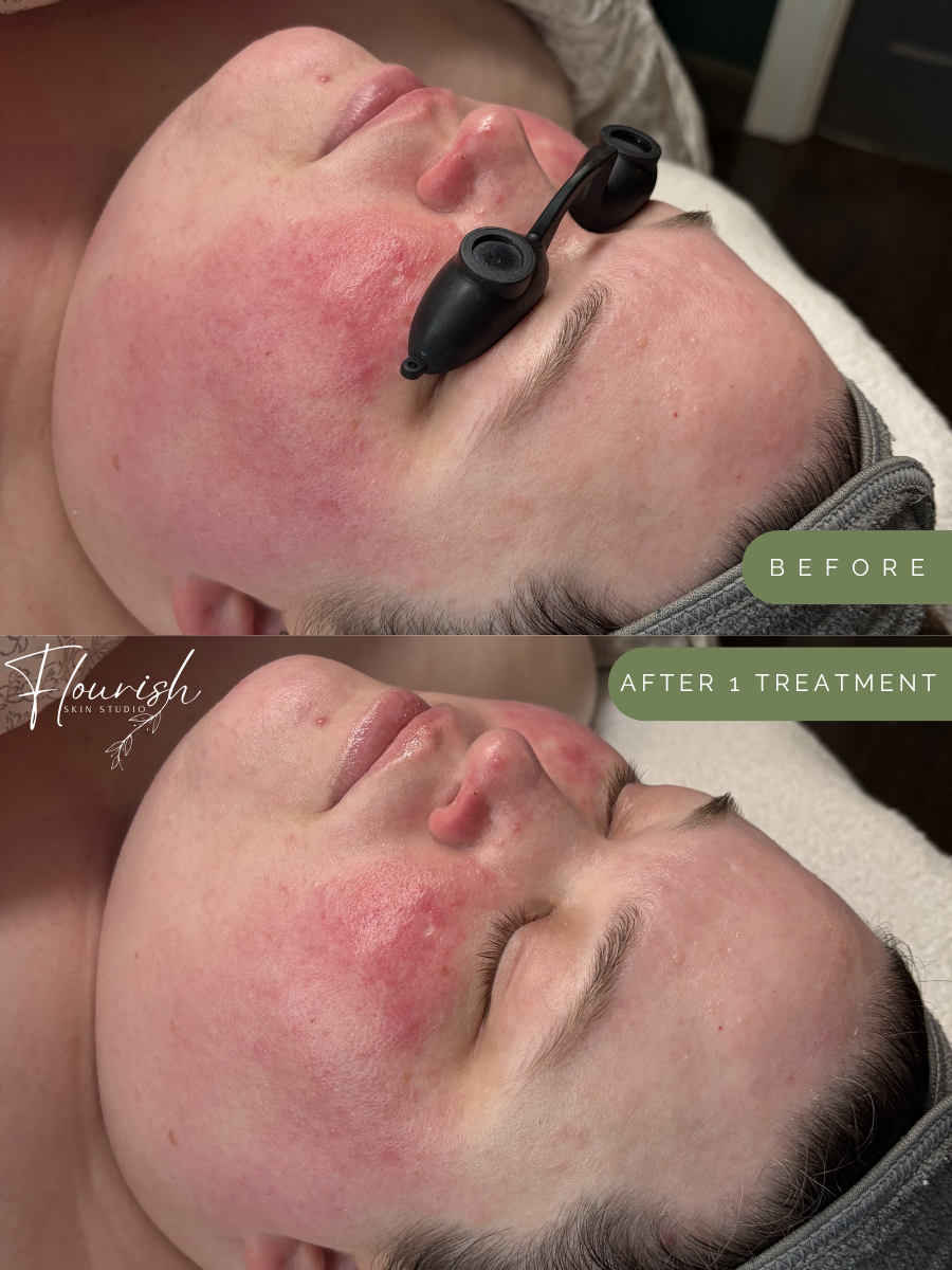 Results after 1 custom facial, plus a custom home-care regimen.