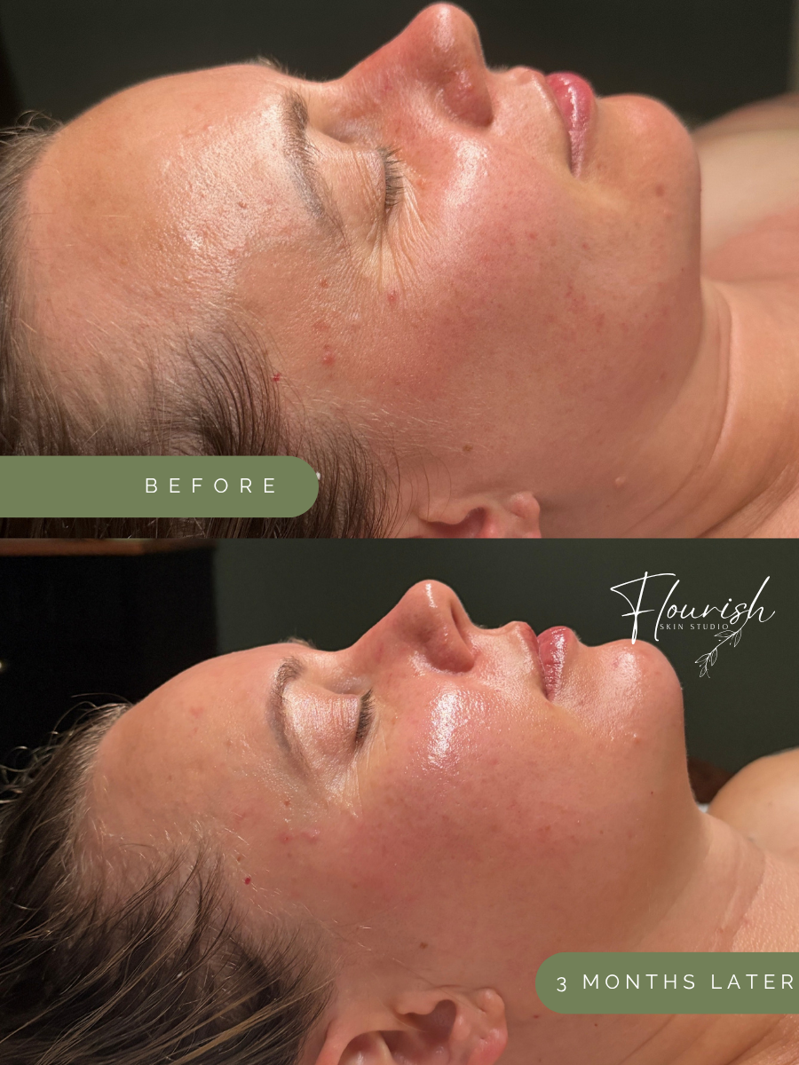 Results after using a custom home-care regimen, 3 custom facials, and 2 microneedling sessions.