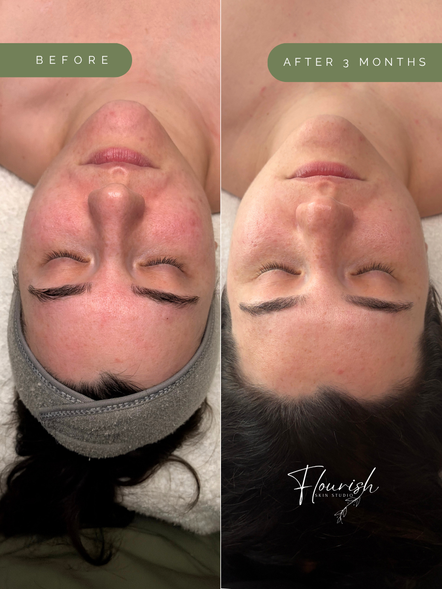 Results after 3 months of a custom home-care regimen and biweekly custom facials and peels.