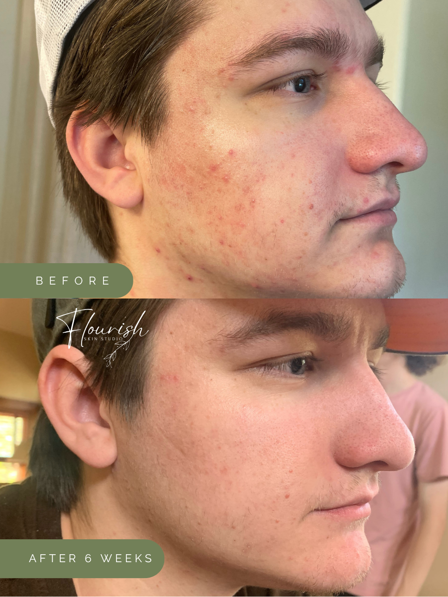 Results after 6 weeks of using a custom home-care regimen, plus one custom facial.