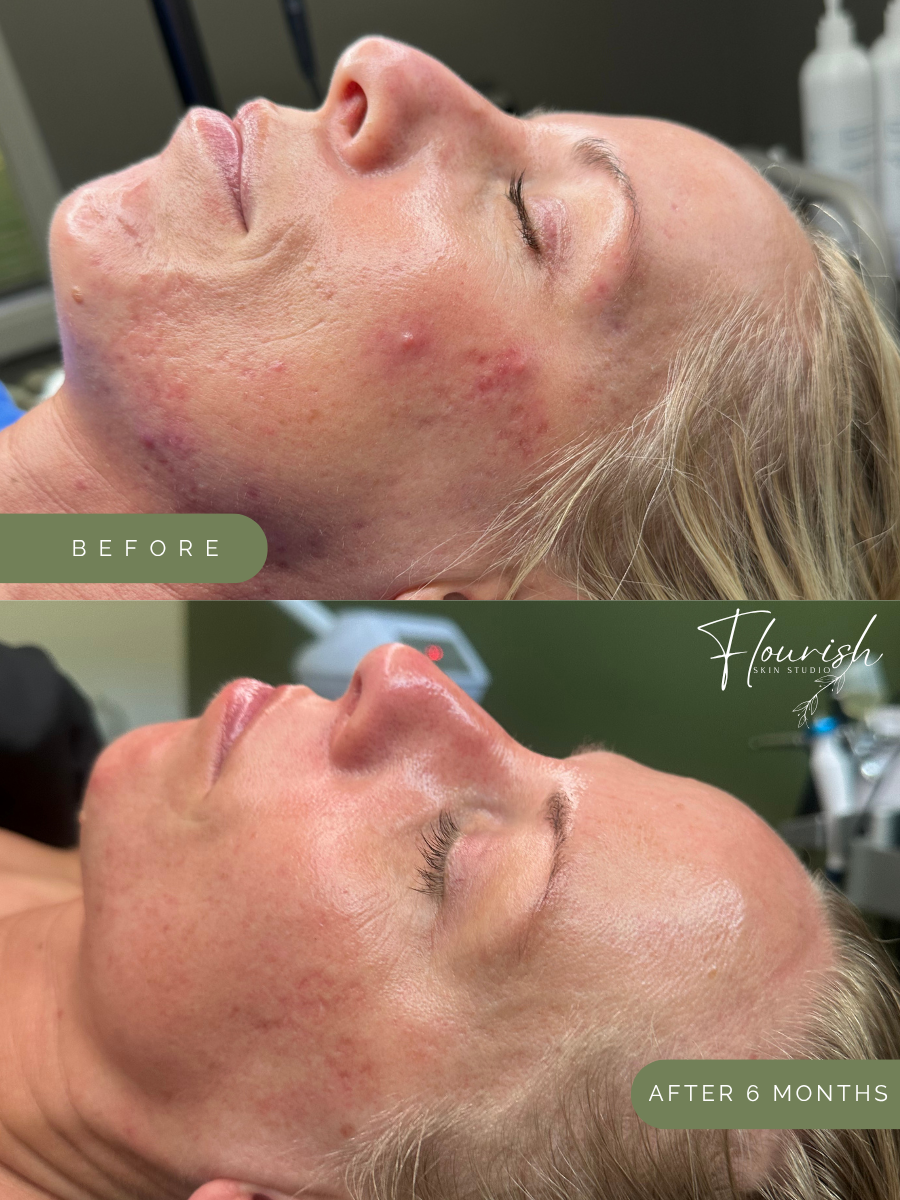 Acne Skin Transformation