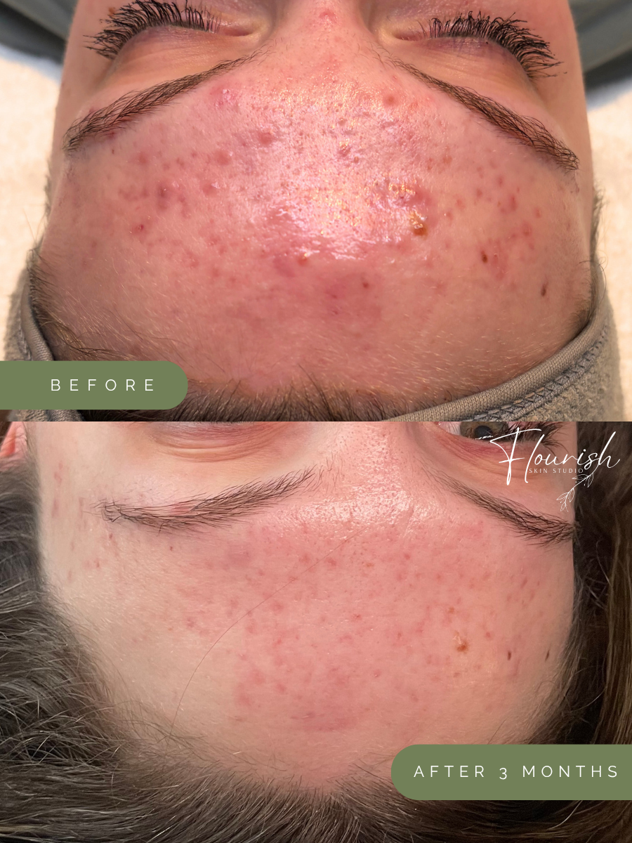 Before and after images showing significant improvement in acne and skin texture over three months, with the top image labeled 'Before' and the bottom 'After 3 Months.'