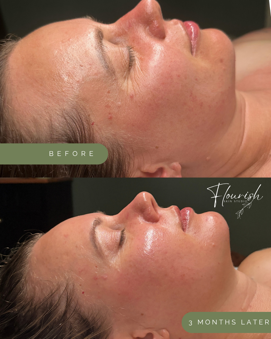 Before and after of microneedling, chemical peels, and custom facials in Tacoma
