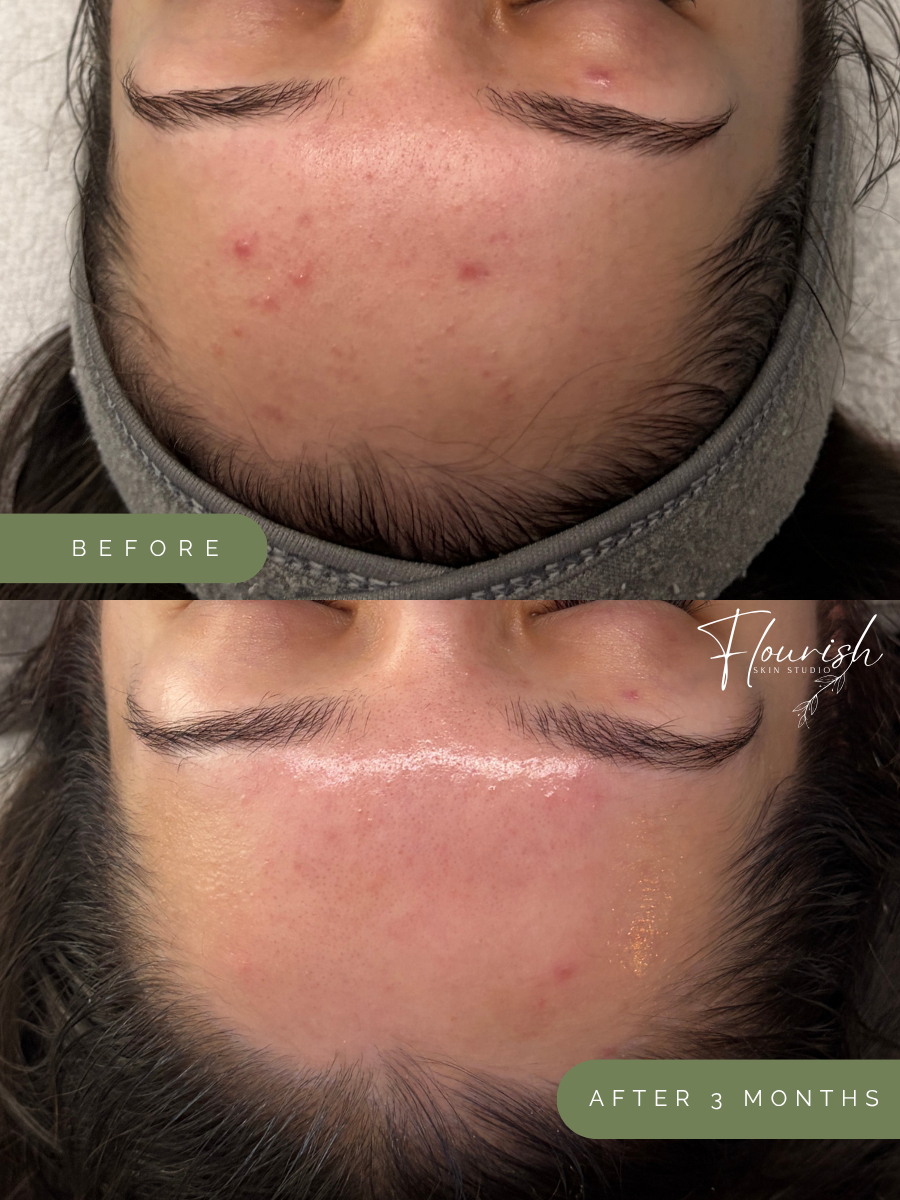 Close-up of a person's forehead showing before and after images of skin treatment. The before image shows acne and blemishes, while the after image shows clearer, smoother skin three months later.