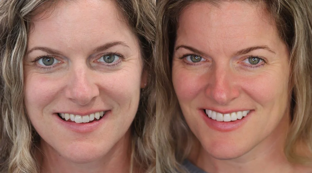 smile makeover_no prep veneers2.jpg
