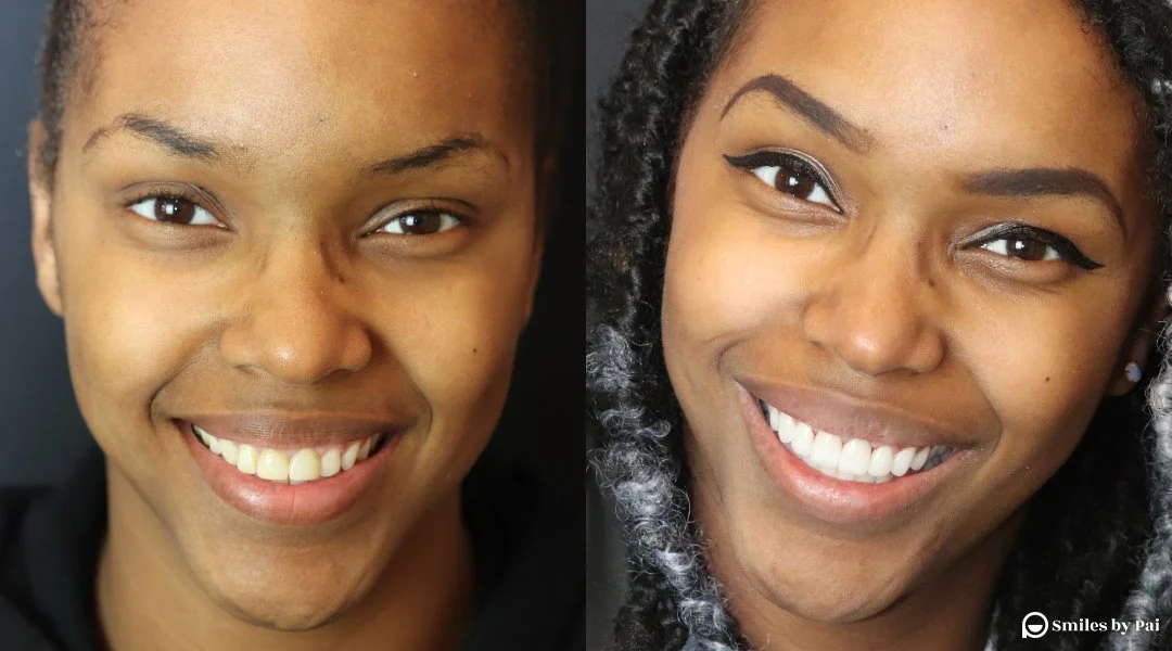 smile makeover_veneers_invisalign_11.jpg