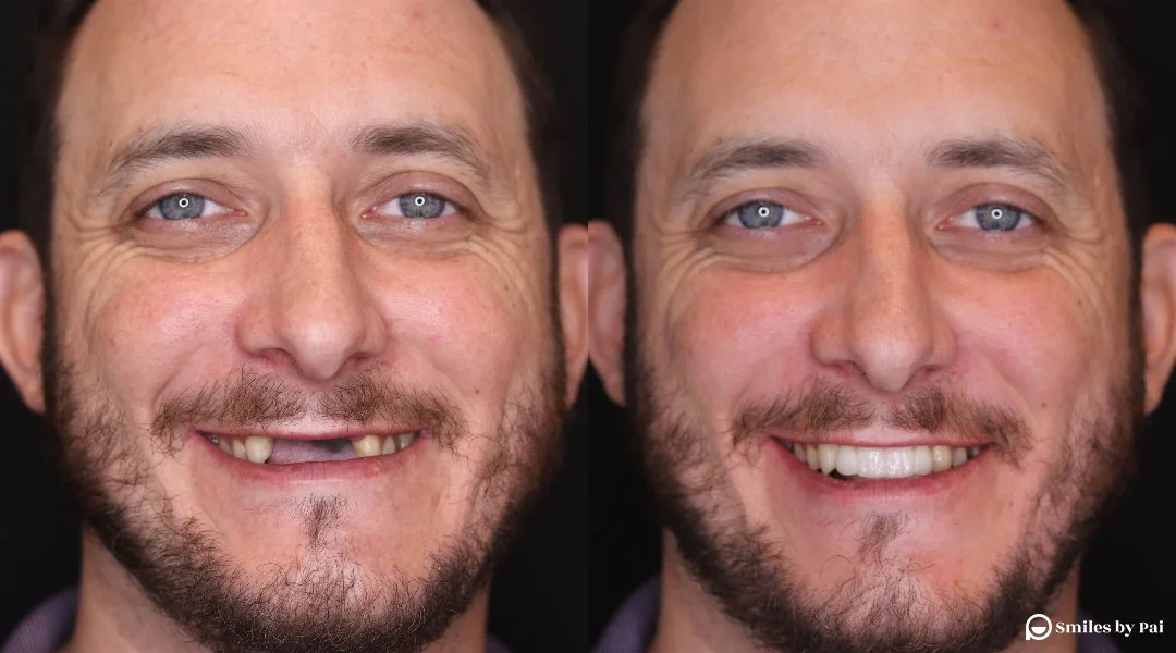 Smile Makeover Case: Dental Implants