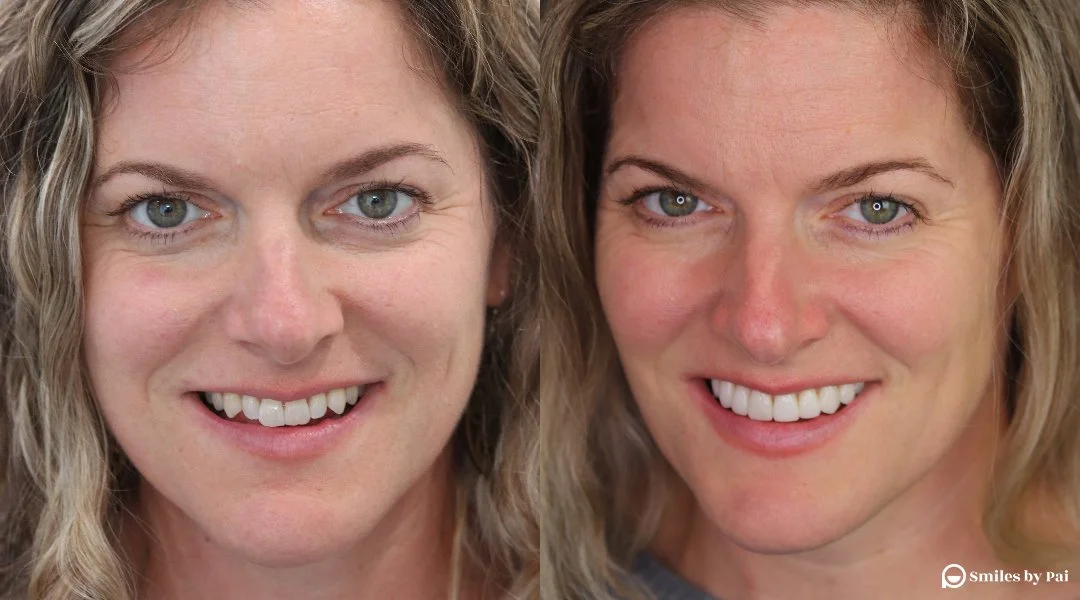 No-Prep Veneers: A Case Study from Smiles by Pai