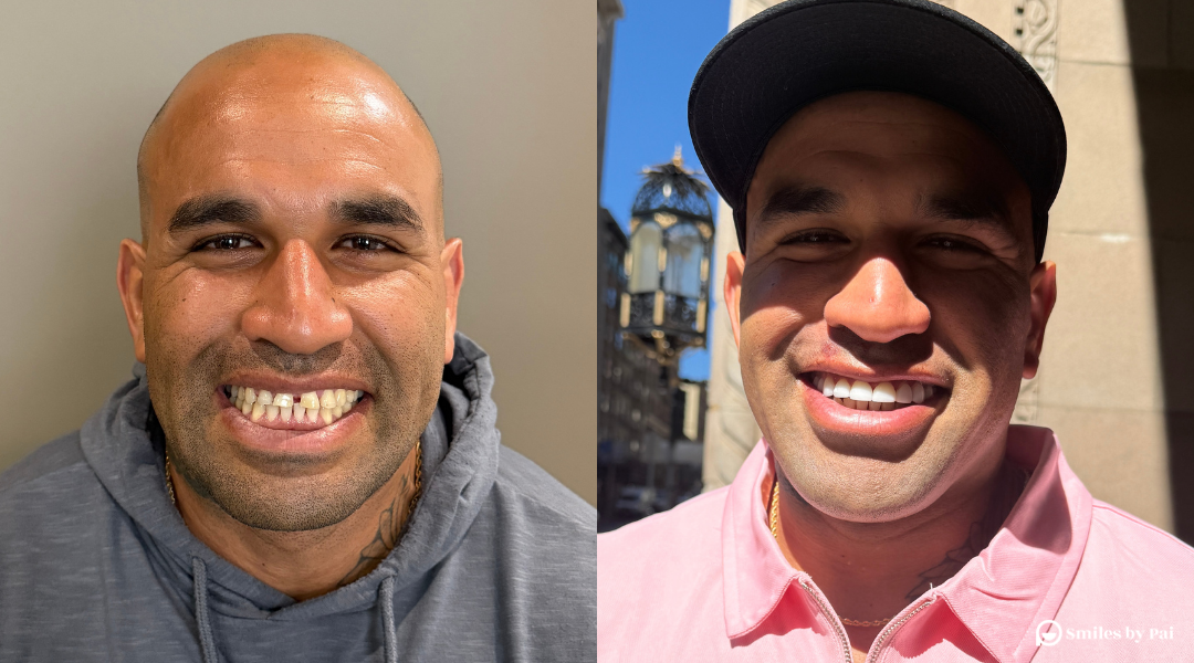 San Francisco No-Prep Veneers: Alo’s Smile Makeover Story