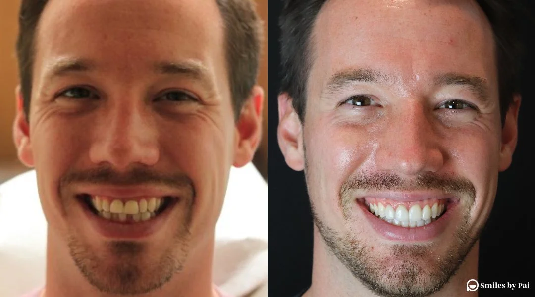 smile makeover_veneers_invisalign.jpg