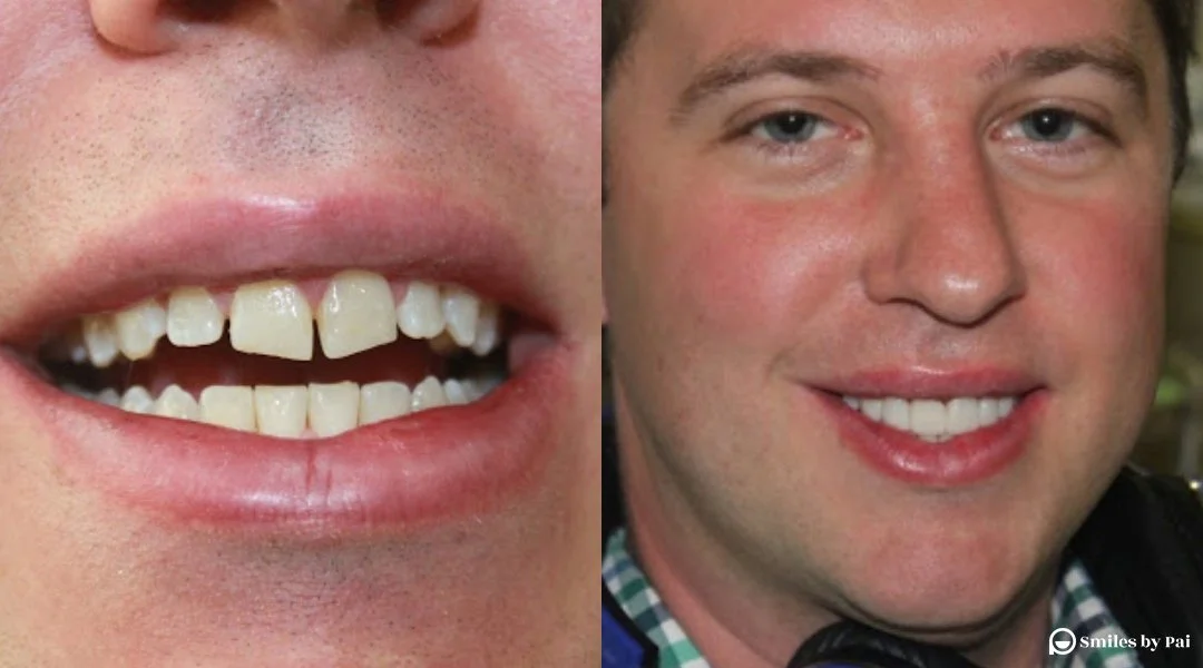 smile makeover_veneers_invisalign_8.jpg