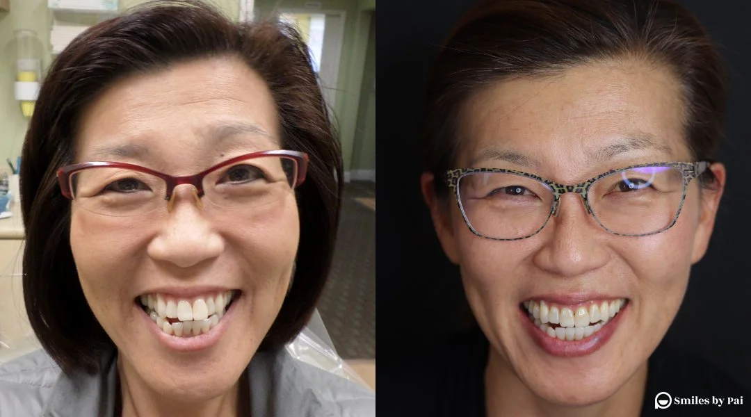 smile makeover_invisalign_3 copy.jpg