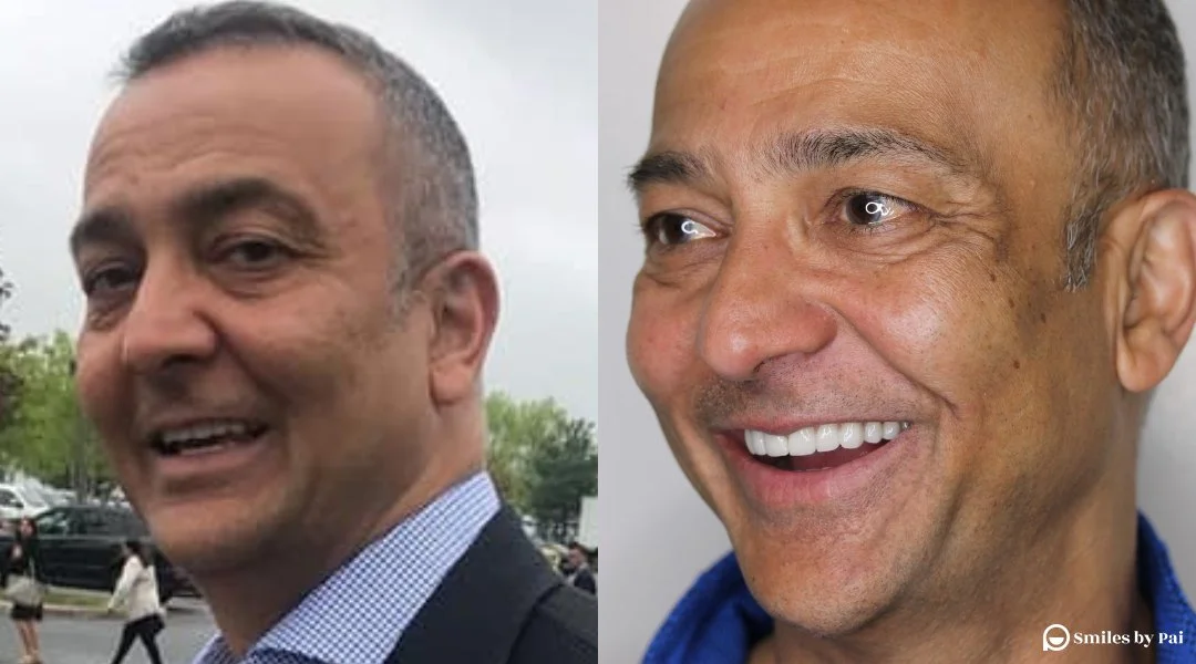 smile makeover_veneers_invisalign_6.jpg