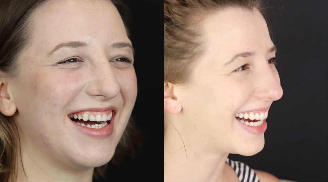 smile makeover_invisalign_6.jpeg