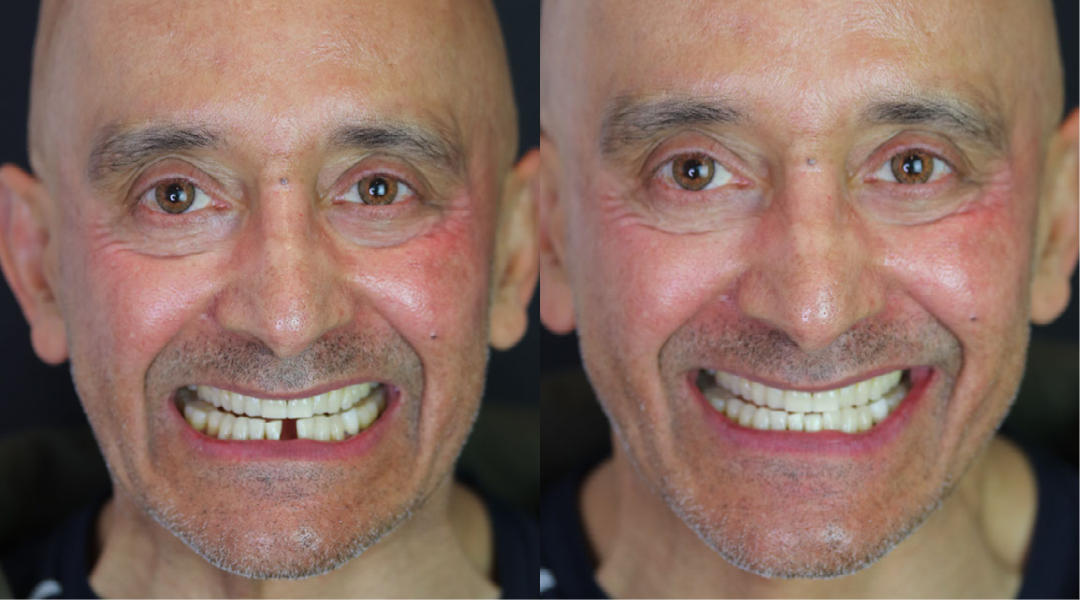smile makeover_dental implant_5.png