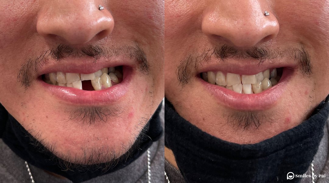 smile makeover_dental implant_4 copy.jpg