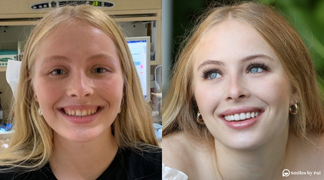 smile makeover_no prep veneers copy.jpg