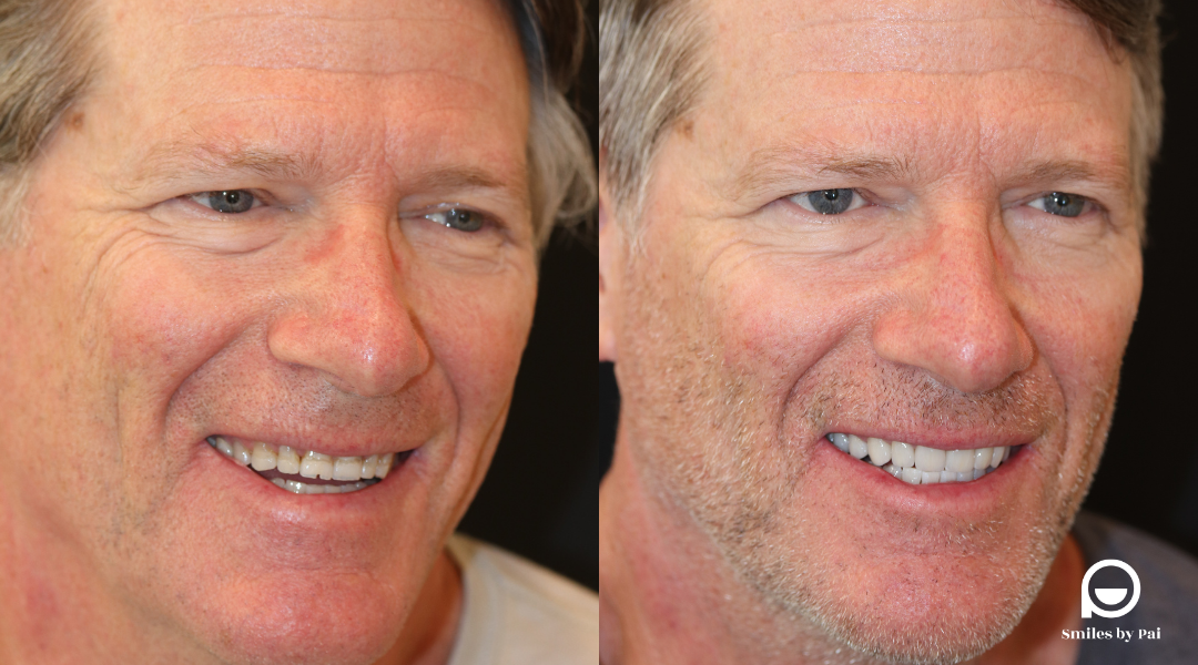 smile makeover_min prep veneers.png