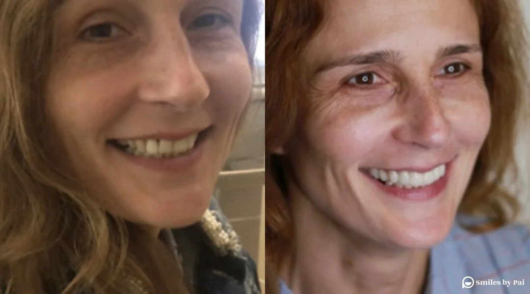 smile makeover_veneers_invisalign_7.jpg