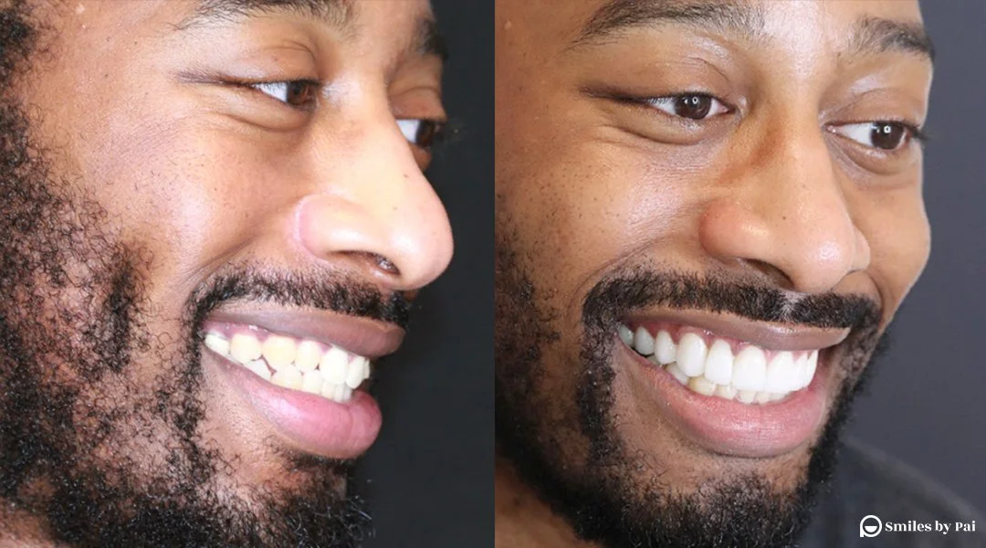 smile makeover_veneers 4.jpeg
