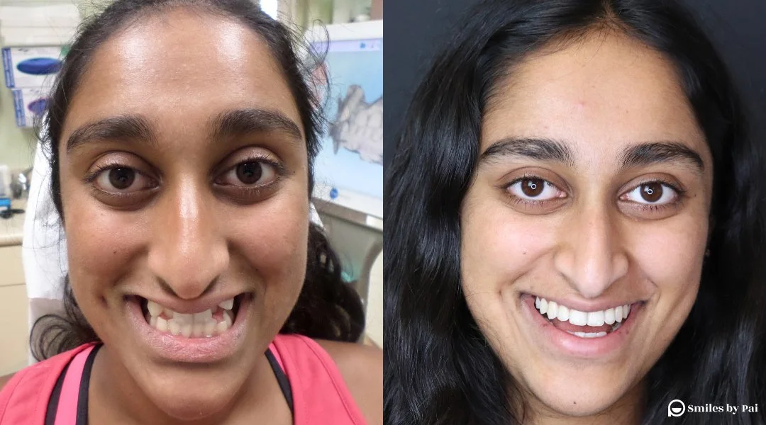 smile makeover_invisalign_4.jpg