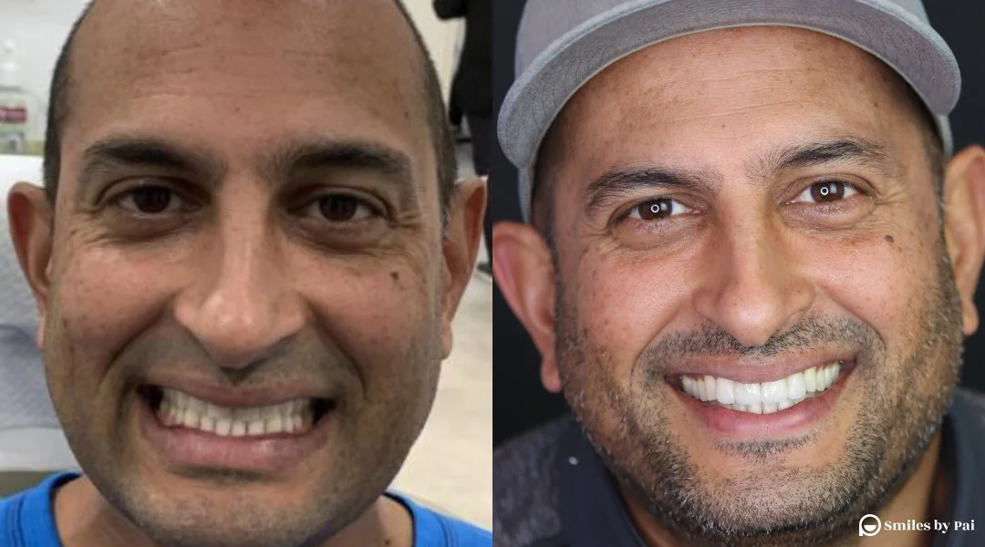 smile makeover_veneers_invisalign_12.jpg