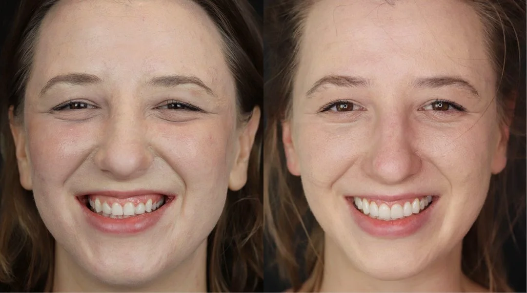 smile makeover_invisalign_5.jpeg